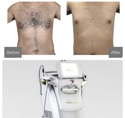 Intensive Pulse Light Hair Removal