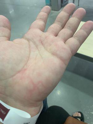 Hives and swelling on hand