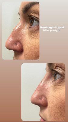 Non-surgical liquid rhinoplasty