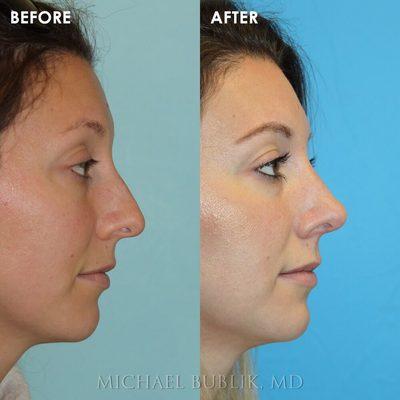 Rhinoplasty ("nose job")