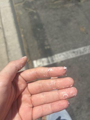 my hands after she melted the acrylic on me