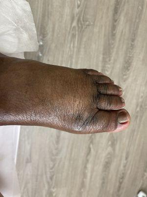 Finished product of diabetic foot care