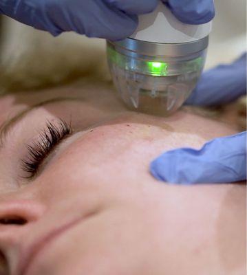 Get ready for flawless skin with our RF Microneedling treatments!