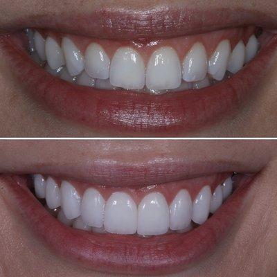 Prepless porcelain veneers. No enamel was harmed or removed for these veneers :)