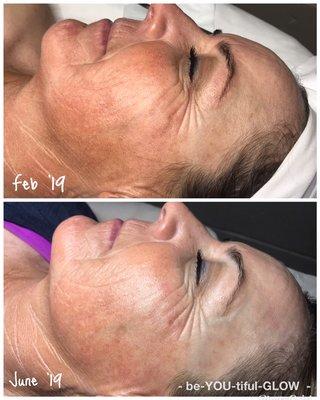 Consistent Dermaplaning facial along with home care regimen does make a difference.