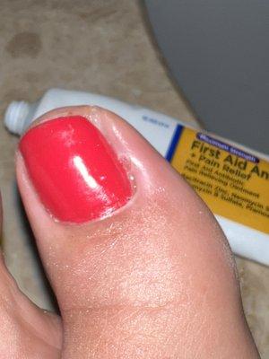 INFECTED toe