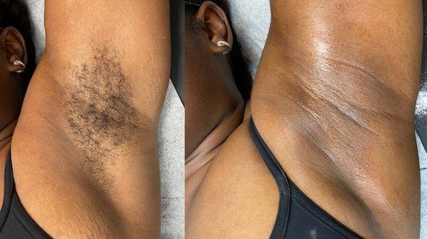 Underarm wax before & after.