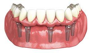 Lower Hybridge Full Arch Dental Implant Restoration