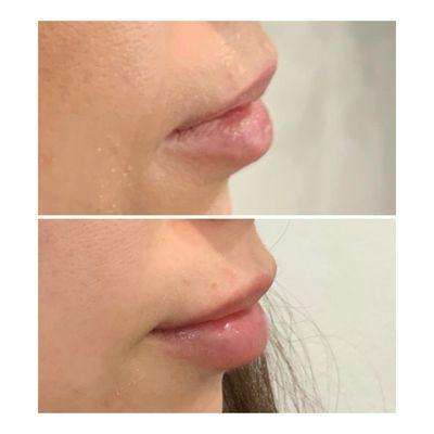 Juvederm Ultra Plus XC Lip Enhancing filler