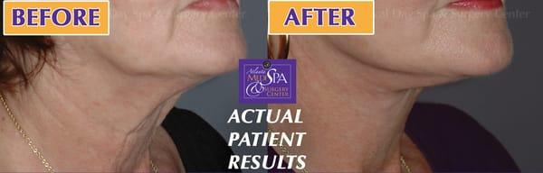 Patients at Atlanta MediSpa and Surgery Center experience amazing results from Exilis Skin Tightening treatments!