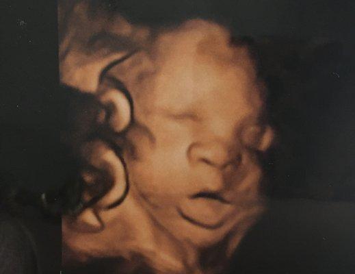 BabyVision Ultrasound