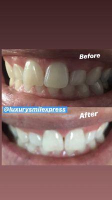 Before and after done by Luxury Smile Xpress.