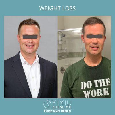 Medical weight loss before and after.