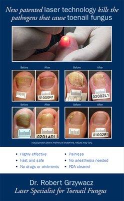 Toenail fungus- laser removal