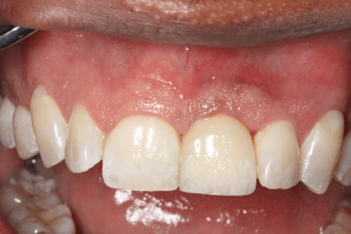 Front tooth implant placed by Dr. Erickson