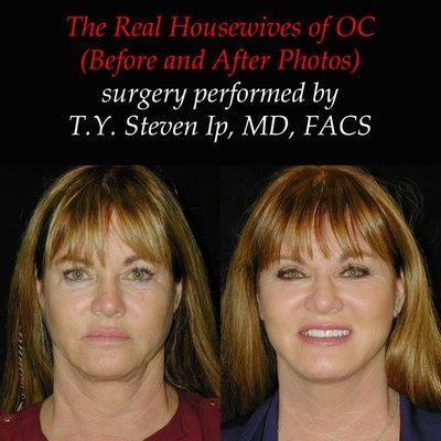 The Real Housewives of OC (RHOC) surgery by T. Y. Steven Ip, MD, FACS