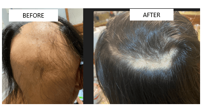 Before and After Treatment