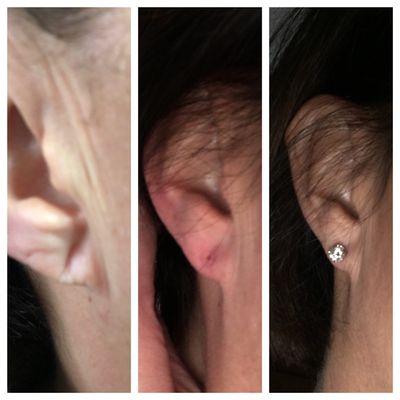 Filler for stretched piercing/earlobes