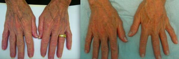 Actual Patient:  Radiesse used for volume loss in hands.