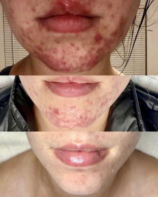 Acne Transformation