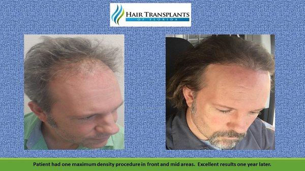 Patient had his front and mid areas transplanted...very happy patient!