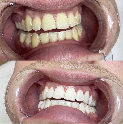 Teeth Whitening for Men and Women