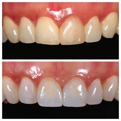 Severe discoloration of two root canal treated central incisors that were restored with two all ceramic crowns