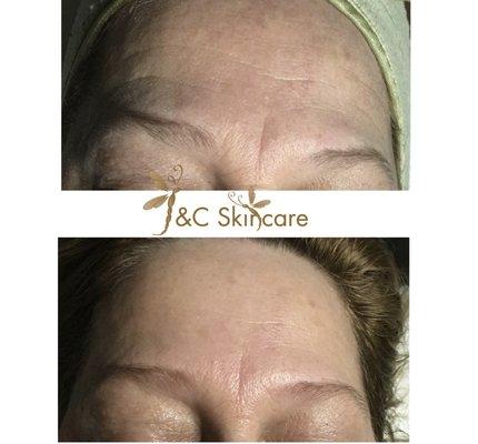 One treatment - from fine lines to pigmentations!