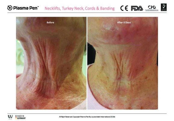 Plasma Pen Fibroblast Necklift and Wrinkle Reduction