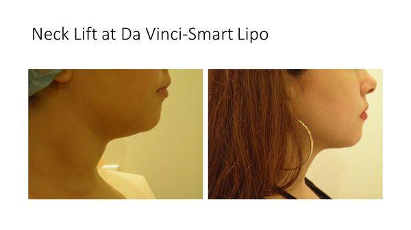 Lunchtime Neck Lift-Smart Lipo