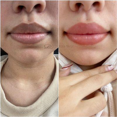 Dark lips correction 1 month HEALED!