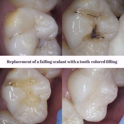 Even those childhood sealants  can fail.  After the sealant and cavity removal, a tooth colored filling is placed.