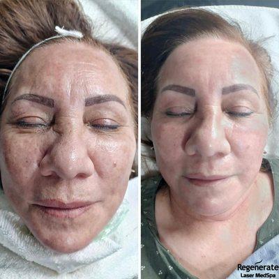 OPUS Plasma 
 Before and Right After treatment