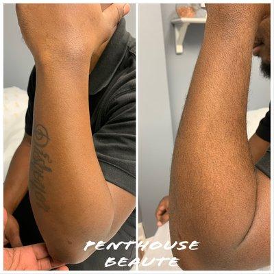 Before and after arm wax