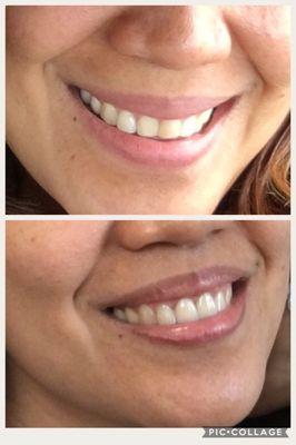 Before & after of my 2 front teeth. Dr. Sylvia did an awesome job.