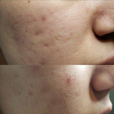 Microneedling improvements after 2 treatments