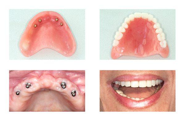 * Implant Supported Dentures: This type of implant denture is used in place of a full denture to replace an entire bridge of missing teeth.