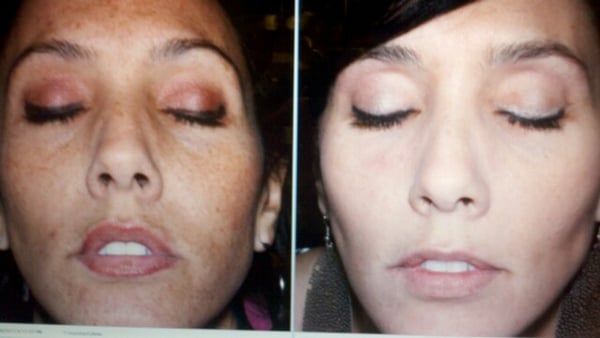 A patient of ours after 5months on the OBAGI Nuderm Regimen