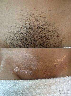 Before and After brazilian wax