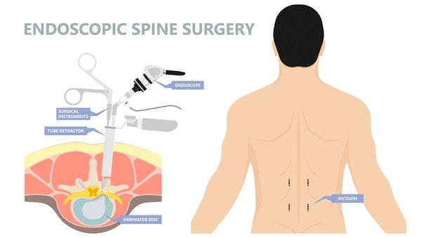 LASE is a Revolutionary minimally invasive procedure that treats disc herniations, spinal stenosis, bone spurs slipped vertebrate, & more.