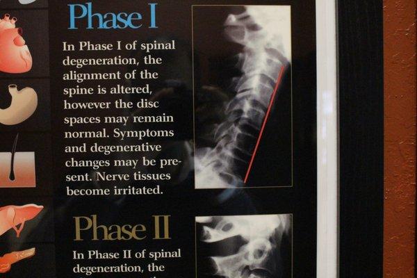 phase 1 of spinal degeneration