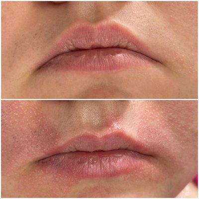 Treatment for inverted smile lines & lip flip