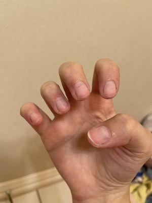 Day after. Cuticles we're all cut and swollen. The dent at the top by my cuticles was from her - my nexgen was more grown out than that.