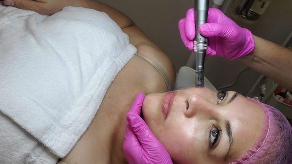 Microneedling