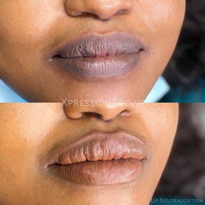 Lip neutralization