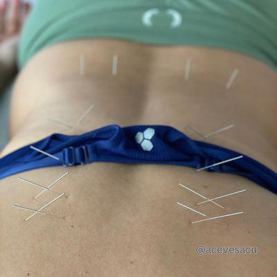 Acupuncture Treatment