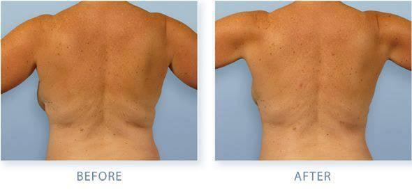 Liposuction for Back Fat