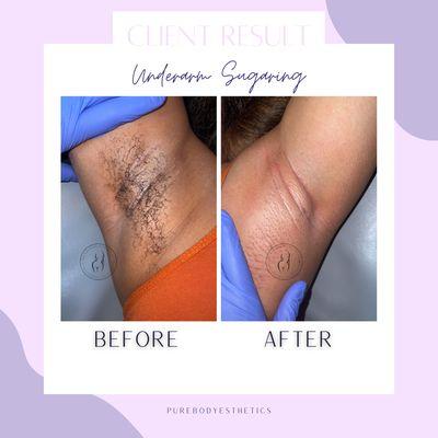 Underarm Sugaring: Before & After!