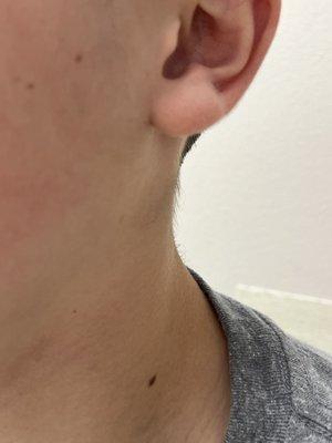 Tufts of hair on neck