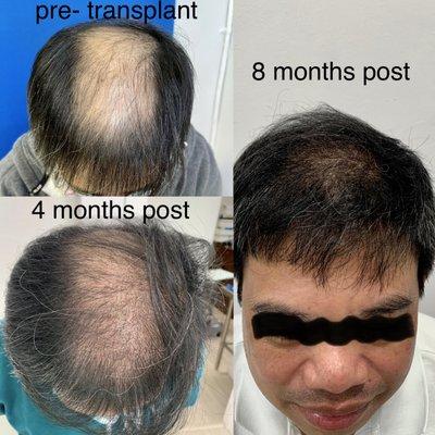 Our FUE hair transplants  can be life changing.